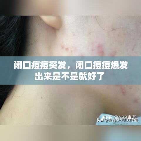闭口痘痘突发，闭口痘痘爆发出来是不是就好了 