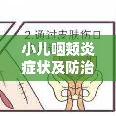 小儿咽颊炎症状及防治，百度权威解答！